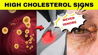 These Signs Tell You That You Have High Blood Cholesterol Warning Signs Of High Blood Cholesterol [upl. by Graves]