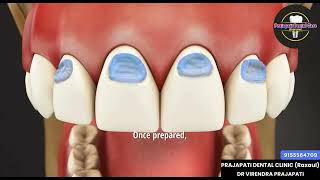 Composite filling in Abfraction tooth [upl. by Hartley269]