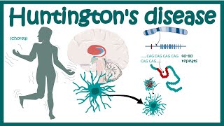 Huntingtons Disease  Pathology of Huntingtons Chorea  Diagnosis of Huntingtons disease [upl. by Elysia]