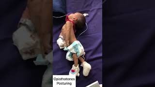 Posturing in newborn opisthotonos  pediatrics shorts newborn pediatrics [upl. by Adnamar65]