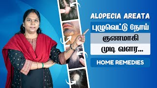 Alopecia Areata Treatment at Home in Tamil  தலை முடியில் புழு வெட்டு  பூச்சி வெட்டு தீர்வுகள் [upl. by Yunfei]