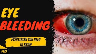 Eye Bleeding Everything You Need To Know [upl. by Dihahs163]