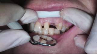 Dental video dd2123 bridge preparation [upl. by Edlyn]