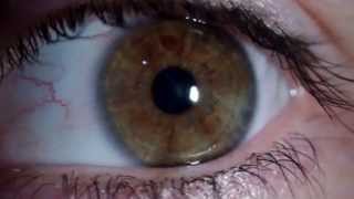 Nistagmus rotatorio  Rotary Nystagmus [upl. by Frere]