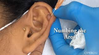 Left Ear Lobe Keloid  Removal [upl. by Naryk]