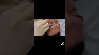 New Dermal Piercing Tommy Ts Body Piercing Huntington Beach California [upl. by Oznola]