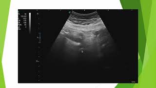 Aspect du pneumopéritoine en échographie [upl. by Odarbil286]