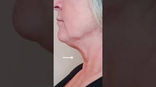 Neck Wrinkles Treatment Before amp After skintreatment [upl. by Ahsino]