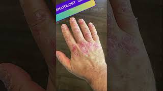 Dermatoses Resulting from Physical Factors Quiz  Part 2 medicalmcqs dermatologyquiz [upl. by Emelun955]