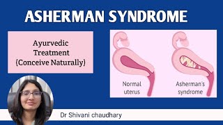 Asherman syndrome  cause symptoms amp ayurvedic treatment in Hindi endometrium ashermansyndrome [upl. by Eelarol]