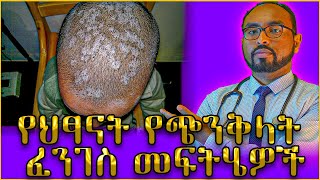 የህፃናት የጭንቅላት ፈንገስ መፍትሄዎች  Dr Fasil [upl. by Yrol325]