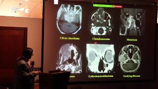 Aneurysmal bone cyst in skull base ABC 13 [upl. by Heilman]