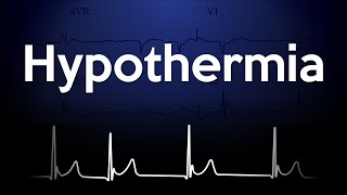 Hypothermia ECG Explained [upl. by Aleakam]