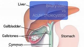 Biliary colic vs acute cholecystitis [upl. by Garrott226]