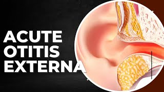 TOPICquot26ACUTE OTITIS EXTERNAamp ITS SYMPTOMS AND TREATMENT [upl. by Lewin]