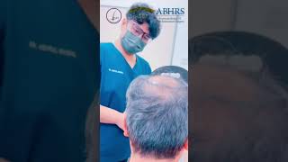 iPlus™️ Covering his hairline middle scalp and crown area for better hair densityKlinik Dr Inder [upl. by Nyrac]