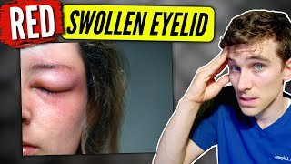 Swollen Eyelid causes amp solutions  Eye Doctor Explains [upl. by Kannav96]