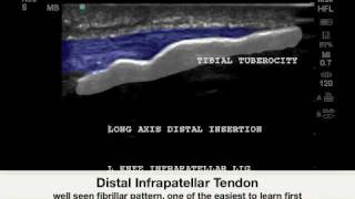 Knee Infrapatellar Enthesopathy  Sonosite Case Study [upl. by Gebhardt]