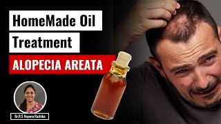 Effective Home Remedy for Alopecia Areata DIY Oil Treatment  Panchayu [upl. by Enovad]