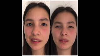 Facial Paralysis amp Bell’s Palsy Reconstruction [upl. by Lyram115]