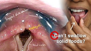 Cricopharyngeal Dysfunction Difficulty Swallowing Especially Solid Foods [upl. by Zetrac]