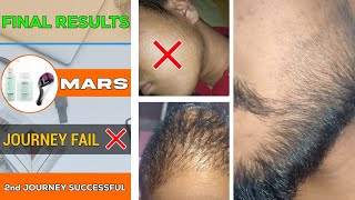 BEARD GROWTH  Journey fail ❌️ Final results from mars minoxidil  2nd journey finally successful [upl. by Enilegnave]