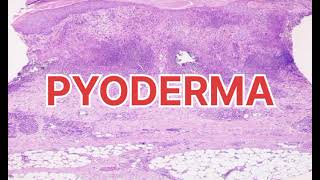 PyodermaType of pyoderma Causes of pyoderma✨ [upl. by Noslrac]