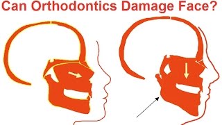 Can Orthodontics Damage Faces by Prof John Mew [upl. by Nosimaj594]