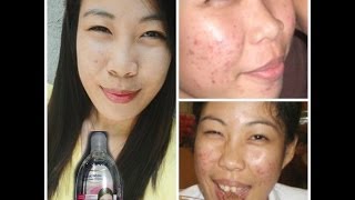 EASY ACNE TREARMENT USING ESKINOL  DALACINC [upl. by Aniez]