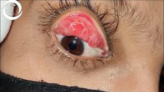 Giant Papillary Conjunctivitis [upl. by Arrik]