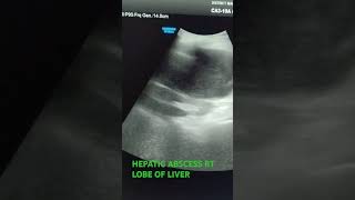 HEPATIC ABSCESS RT LOBE usg [upl. by Sarena281]