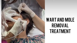 Wart removal treatment shortsvideo wart youtubeshort viralvideos trending aesthetic [upl. by Nickie210]