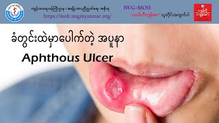 ခံတွင်းထဲမှာပေါက်တဲ့အပူနာ Aphthous Ulcer [upl. by Byrann]