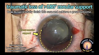 CataractCoach 1232 traumatic loss of zonular support [upl. by Notreb233]