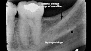 Dental Radiographic Anatomy [upl. by Lalittah777]