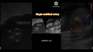 Single umbilical arterywhat is it sua [upl. by Brockwell]