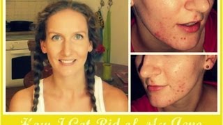 How I Got Rid of My Acne  OCM Mistakes Tips Skincare Routine  Photos  VitaLivesFree [upl. by Flore940]