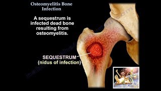 Osteomyelitis Bone Infection  Everything You Need To Know  Dr Nabil Ebraheim [upl. by Inavoig144]