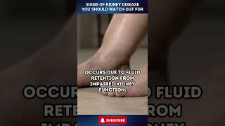 Signs of Kidney Disease You Should Watch Out For shorts [upl. by Anma]