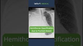 Hemithorax Opacification Pushed Alveoli Explained 🩺 ChestXray Radiology USMLE [upl. by Haibot]