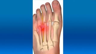 Hablamos sobre adormecimiento en los dedos de los pies [upl. by Alohs]