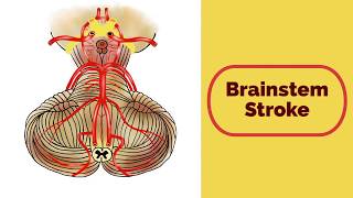 Brainstem Stroke Syndromes [upl. by Josephson]