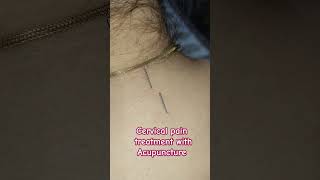 Acupuncture treatment for cervical spine acupuncturists painrelief [upl. by Aneeroc]