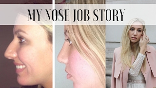 MY NOSE JOB  RHINOPLASTY STORY BEFORE amp AFTER  Scarlett London [upl. by Lesslie]