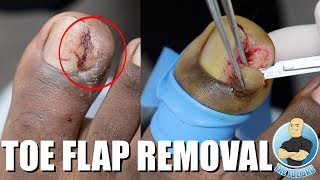 TOE FLAP REMOVAL OF FLESHY INGROWN TOENAIL [upl. by Reddy632]