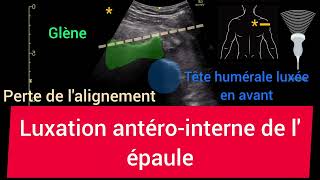 Luxation antérointerne de lépaule Glénohumérale Échographie [upl. by Enelrahc649]