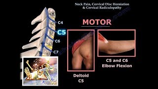 Neck Pain Cervical Disc Herniation amp RadiculopathyEverything You Need To Know  Dr Nabil Ebraheim [upl. by Eiramave251]