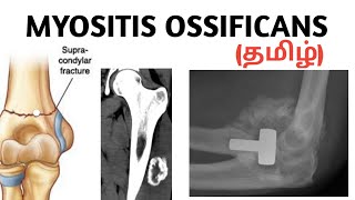 Myositis ossificans  causes  symptoms  treatment தமிழ் [upl. by Oinafipe191]