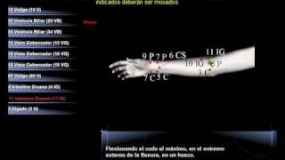 Tratamiento de la Artrosis y Artritis Cervical cuello con digitopuntura [upl. by Nithsa190]