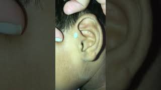 Squeezing preauricular pit earpit satisfying pimplepopping [upl. by Menzies]